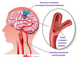 Атеросклероз магистральных сосудов головного мозга: симптомы и лечение