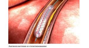Атеросклероз сосудов верхних конечностей: симптомы и лечение