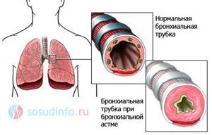 Сердечная астма: причины, симптомы, первая помощь и лечение