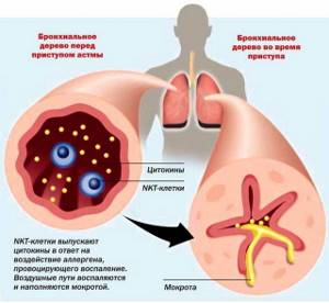 Приступ астмы: механизм развития, симптомы проявления, первая помощь и лечение