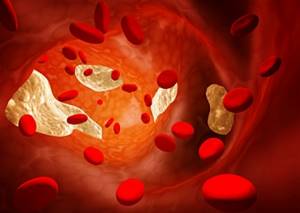 Чем опасен повышенный холестерин в крови у мужчин и женщин