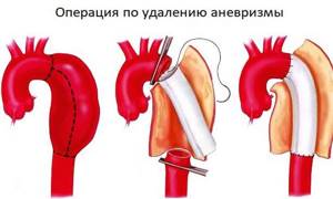 Эндартерэктомия: каротидная (при атеросклерозе сонной артерии) и нижних конечностей