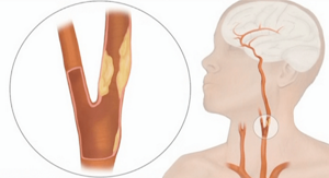 Атеросклероз сосудов шеи: симптомы, признаки, лечение, диагностика и профилактика