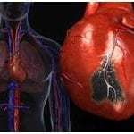 Атеросклероз коронарных артерий: симптомы, лечение, код по МКБ 10