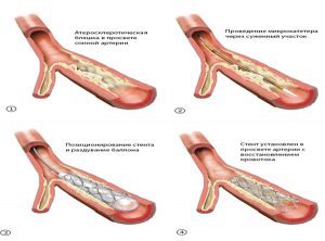 Бляшки в сосудах шейного отдела: как избавиться от холестериновых отложений в сонной артерии шеи