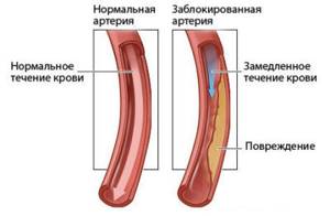 Атеросклероз почечных артерий: причины, симптомы, код по МКБ 10