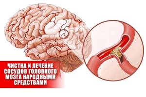 Лечение сосудов головного мозга лекарства и народные средства