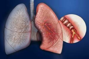 Лечение астмы народными средствами: методы и популярные рецепты
