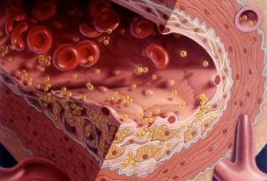 Киви от холестерина: как принимать для снижения холестерола в крови