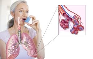 Показатель иммуноглобулина Е при бронхиальной астме в анализе крови