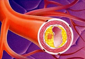 Атеросклероз аорты сердца: что это, симптомы, лечение, код по МКБ 10