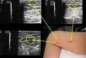Дуплексное сканирование сосудов (вен и артерий) нижних конечностей: что это такое, показания и оценка результатов обследования