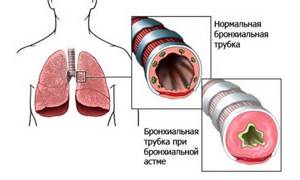 Профессиональная астма: причины, симптомы, лечение и профилактика