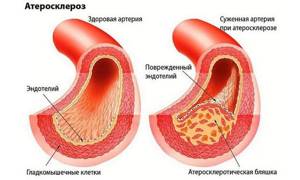 Норма холестерина в крови: таблица по возрасту и полу с расшифровкой
