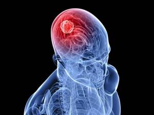 Атеросклероз сосудов головного мозга: симптомы и лечение, код по МКБ 10