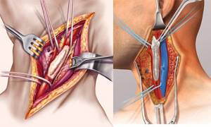 Эндартерэктомия: каротидная (при атеросклерозе сонной артерии) и нижних конечностей
