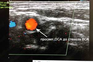 Дуплексное сканирование брахиоцефальных артерий (ДС БЦА шеи): что это за обследование, показания и оценка диагностики