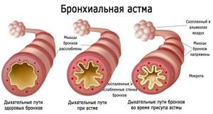 Патогенез бронхиальной астмы: механизмы развития разных форм болезни