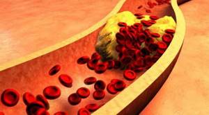 Как снизить холестерин в крови у женщин и мужчин: способы понизить и привести в норму уровень плохого холестерола