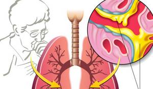 Интермиттирующая бронхиальная астма: особенности течения и лечения