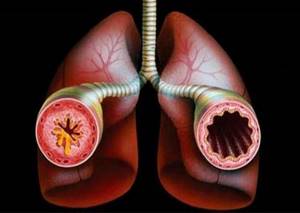 Дексаметазон при астме: действие, показания, противопоказания