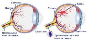 Атеросклероз сетчатки глаза: что это, лечение и профилактика