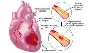 Атеросклероз аорты сердца: что это, симптомы, лечение, код по МКБ 10