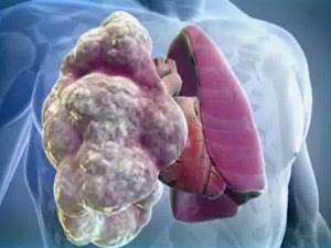 Беродуал при астме: действие, формы выпуска, способы применения