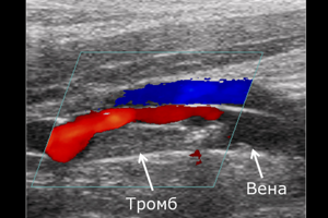 УЗИ сосудов (вен и артерий) нижних конечностей: что показывает, как делают и как подготовиться к исследованию