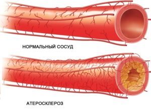 Атеросклероз сердца: что это такое, симптомы и лечение, риск смерти