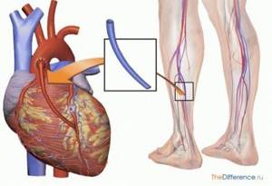 Шунтирование и стентирование сосудов сердца – в чем разница, что лучше и когда делают