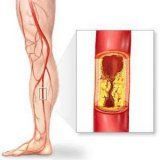Атеросклероз сосудов нижних конечностей: симптомы и лечение, код по МКБ 10