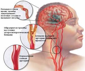 Лечение атеросклероза сосудов головного мозга: препараты и лекарства