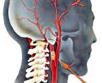 Атеросклероз сонных артерий: что это такое, лечение, симптомы, код по МКБ