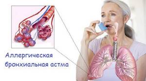 Аллергическая астма: механизм развития, причины, симптомы, лечение