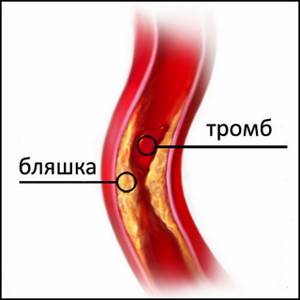 Бляшки в сосудах шейного отдела: как избавиться от холестериновых отложений в сонной артерии шеи