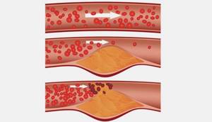 Холестериновые бляшки в сосудах: что это, как проверить наличие атеросклеротических бляшек и тромбов