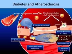 Патогенез атеросклероза при сахарном диабете (зарождение и развитие)