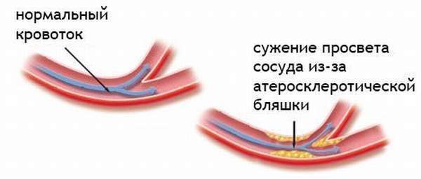 Атеросклероз сонных артерий: что это такое, лечение, симптомы, код по МКБ