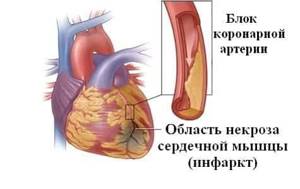 Атеросклероз сердца: что это такое, симптомы и лечение, риск смерти