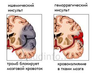 Реоэнцефалография (РЭГ) сосудов головного мозга: что это такое, что показывает, как расшифровать результат