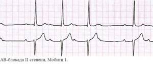 Блокады сердца (i, ii степени, полная): что это такое и как лечить