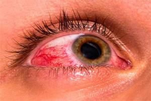 Как снизить повышенное глазное давление: лечение народными средствами в домашних условиях