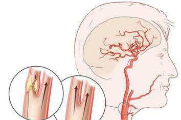 Что такое церебральная ангиодистония и какое ее лечение
