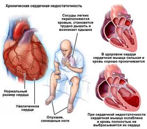 Причины низкого верхнего давления при нормальном нижнем