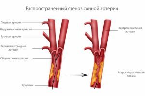 Нестенозирующий и стенозирующий атеросклероз брахиоцефальных артерий