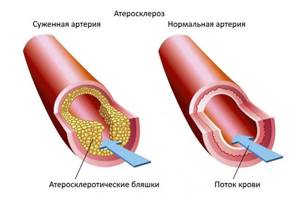 Склероз (уплотнение) и атеросклероз аорты: описание, симптомы и лечение