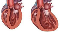 Дилатационная кардиомиопатия: что это такое, и от чего наступает смерть