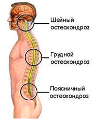 Аритмия и остеохондроз грудного или шейного отдела позвоночника