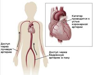 Коронарография сердца: описание процедуры, показания и последствия
